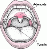 Adenoids and tonsils